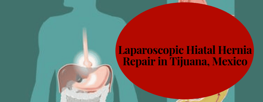 Laparoscopic Hiatal Hernia Repair in Tijuana, Mexico